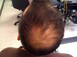 Wikipedia Hair Loss Online Info