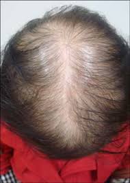 Targeted Hormone Therapies for Breast Cancer & Their Hair Loss