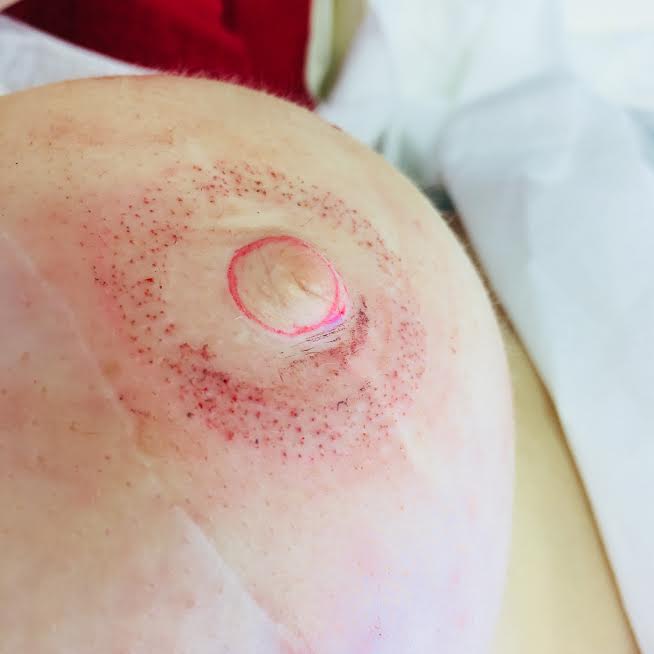 Nipple Tattoos to Complete My Breast Cancer Mastectomy Reconstruction