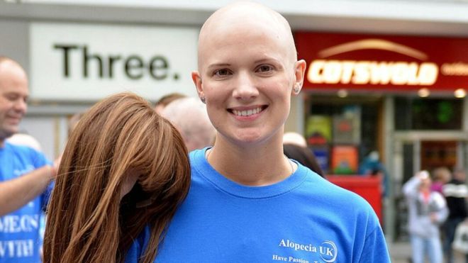Too Young to Go Bald : Alopecia UK say NHS should provide 1 wig a year!