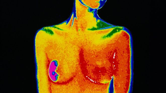 BBC Article about Breast Cancer and Hormone Therapy