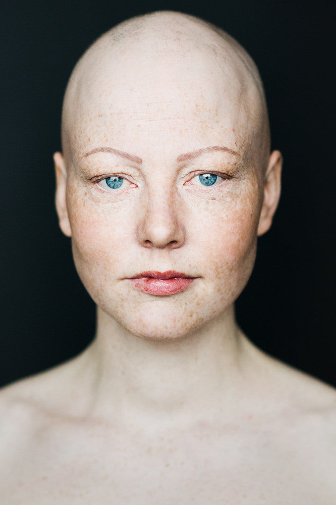 Portraits of Women with Alopecia Redefine Femininity